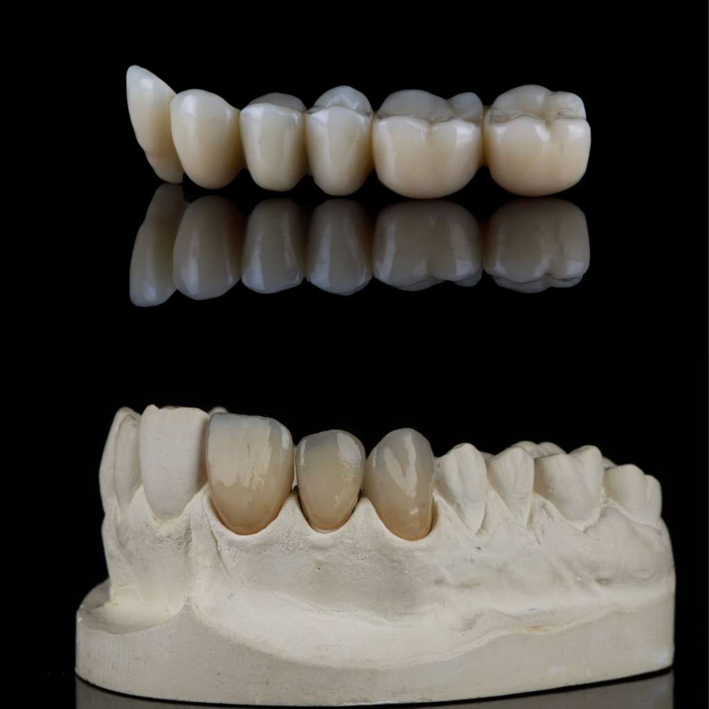 Zwei Vollkeramikbrücken davon die untere auf einem Gipsmodell