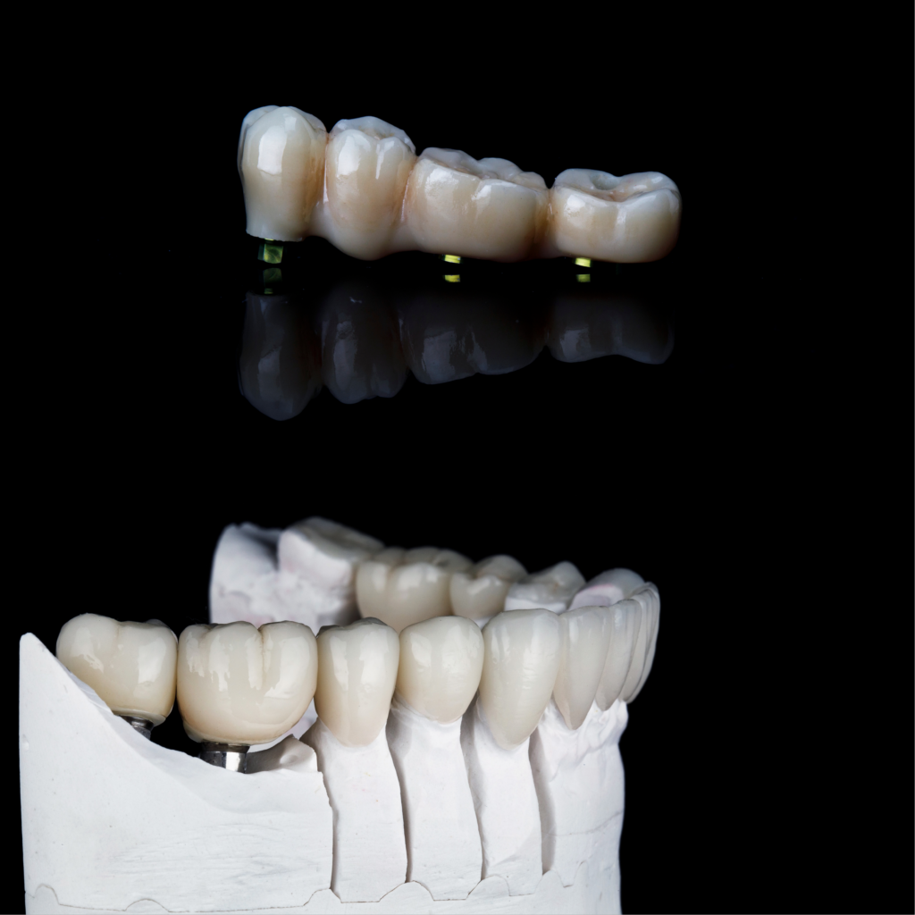 Zweimal implatatgetragener Zahnersatz davon der untere auf einem Gipsmodell