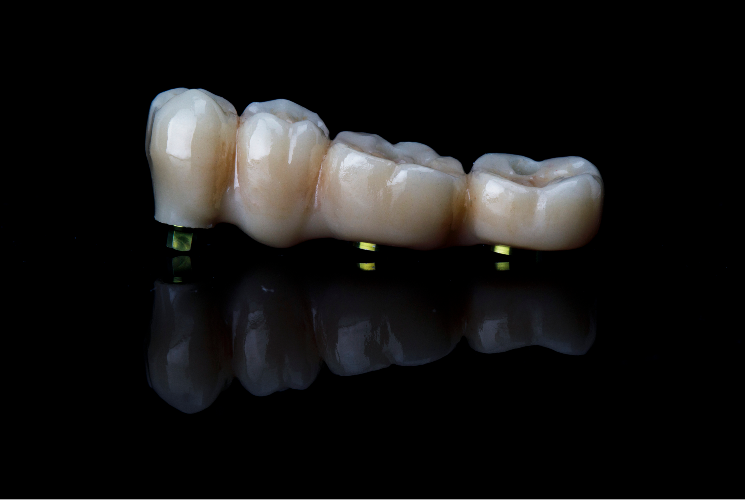 implatatgetragener Zahnersatz auf schwarzem Hintergrund
